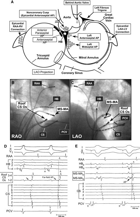 Catheter Ablation Of Paroxysmal Supraventricular Tachycardia Circulation