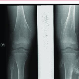 Anteroposterior And Lateral X Ray Views Showing The Osteochondromas On