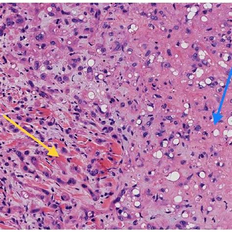 Areas Of Epithelioid Cells Blue Arrow And Spindle Cells Yellow