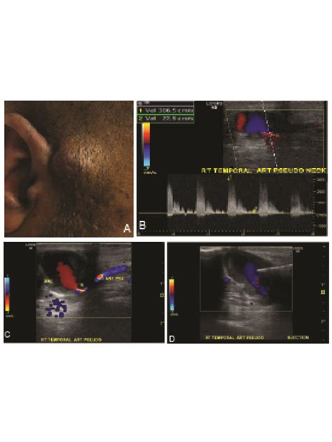 Temporal Artery Ultrasound