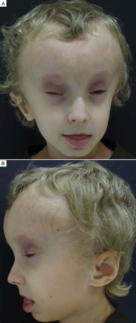 Figure 1 From Ophthalmic Manifestations In A Case Of Wiedemann