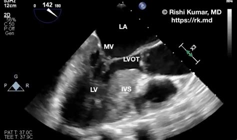 Surgical Septal Myectomy | RK.MD