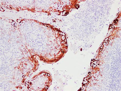 Epithelial Membrane Antigen Ema For Ivd Ihc Pathology Usciencecorp