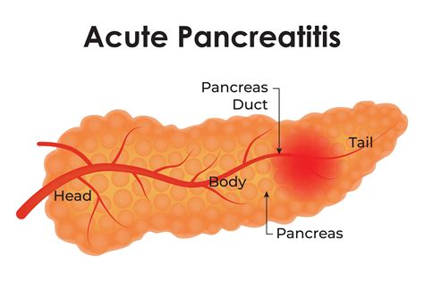 Acute Pancreatitis Head Body Pancreas Graphic by AS Ashik · Creative