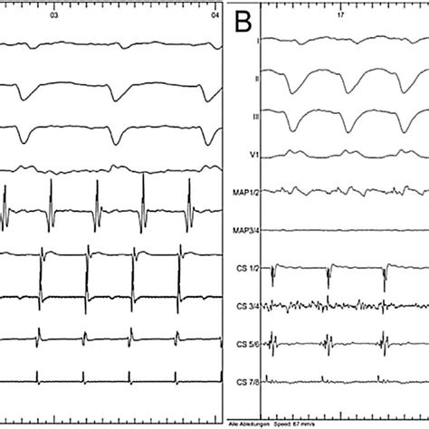 A Intracardiac Ecg Demonstrates Atrial Flutter With 21 Conduction Download Scientific