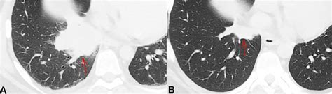 Atezolizumab Induced Encephalitis In A Patient With Metastatic Breast Cancer A Case Report And