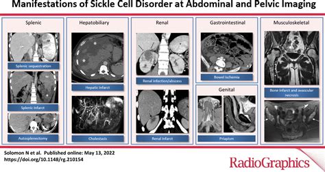 Manifestations Of Sickle Cell Disorder At Abdominal And Pelvic Imaging