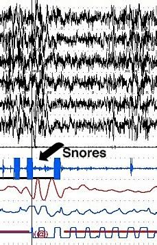 Sleep apnea - wikidoc