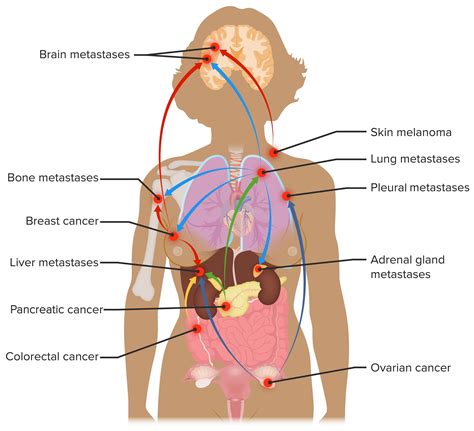 Metastasis (Metastatic Cancer): Definition, Biology Types, 49% OFF