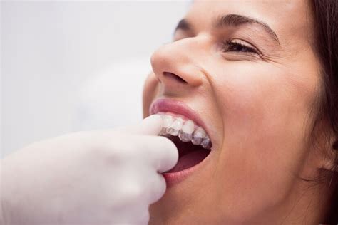 Cu Nto Dura Un Tratamiento De Ortodoncia Invisalign Oralit