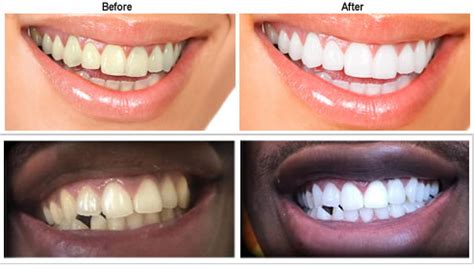 Teeth Whitening Maxident Clinic