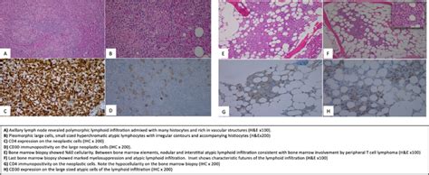 The pathological specimens of axillary lymph node and bone marrow... | Download Scientific Diagram