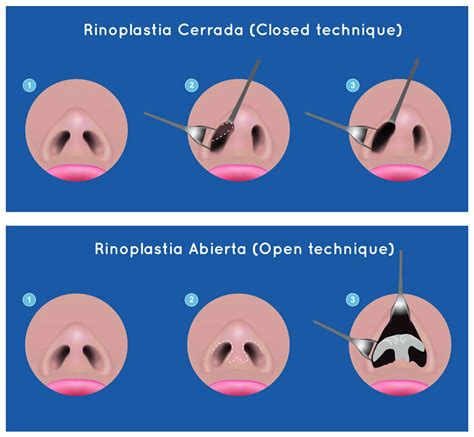 Diferencias Entre Rinoplastia Abierta Y Rinoplastia Cerrada