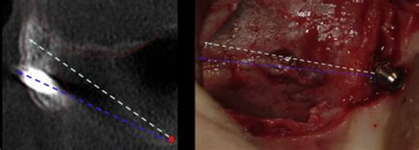 Zygomatic Implants Operative Consideration To Minimize Technical Errors