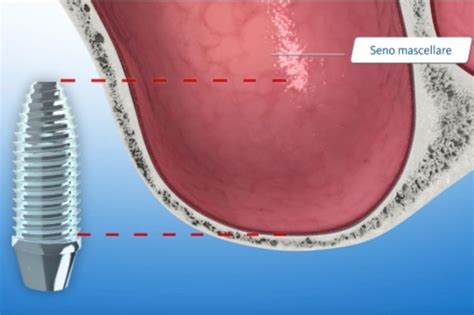 Grande Rialzo Seno Mascellare Clinica Villa