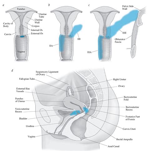 Cancer: Cervical Cancer Stages