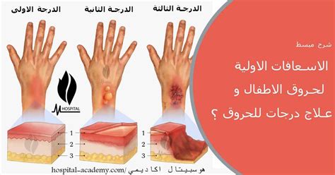 الاسعافات الاولية لـ حروق الاطفال و علاج الـ 3 درجات للحروق