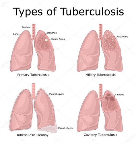 Ilustraci N Diferentes Tipos Tuberculosis Primaria Miliar Cavitaria