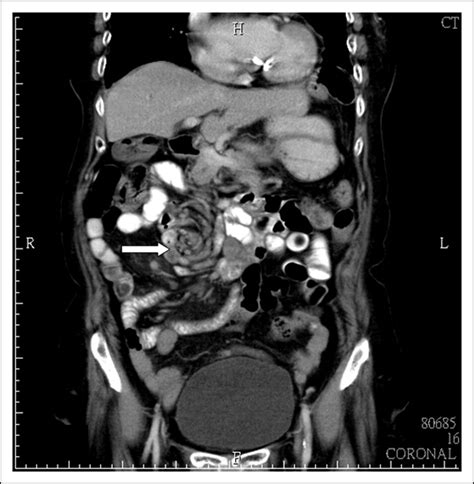 Midgut Volvulus In An Adult With Congenital Malrotation The American Journal Of Surgery