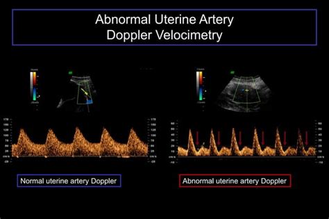 Color Doppler In Fetal Hypoxia PPT