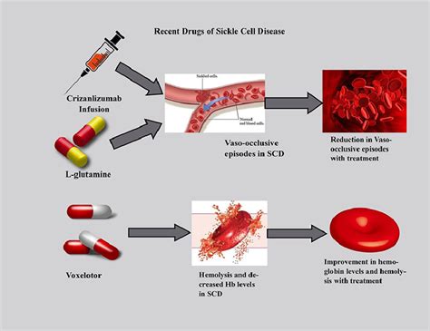 Treatments, Therapies & Clinical Trials — Sickle Cell Foundation of ...