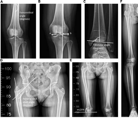 Varus Vs Valgus Fracture