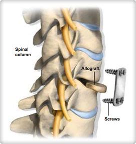 Cervical Discectomy And Fusion