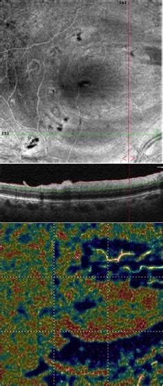 internal limiting membrane ilm adapted en face optical coherence
