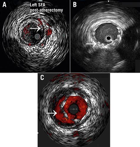 Intravascular Ultrasound Guidance For Lower Extremity Arterial And