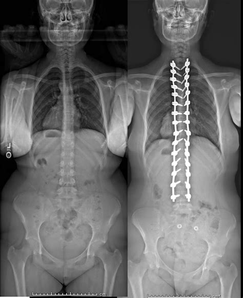 Scoliosis Overview Scoliosis Texas