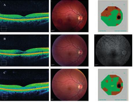 Oct Images Left Fundus Photographs Middle And Visual Field