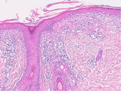 H&E histology of a LE skin biopsy sample reveals an interface... | Download Scientific Diagram