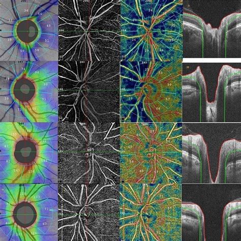 First row: Color fundus photography of NAION patient without carotid ...