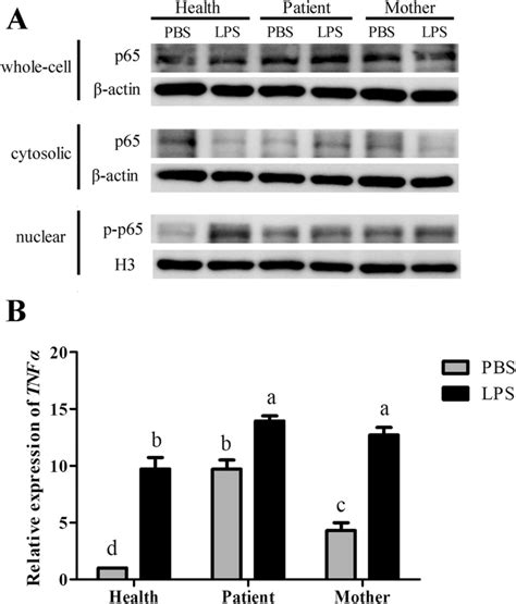 Nf κb Activation In The Patient A The Protein Levels Of P65 P P65 In