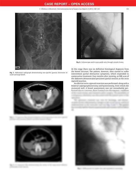 Solution Acute Endometrial Bowel Obstruction A Rare Indication For