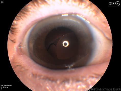 Dislocated Posterior Chamber Intraocular Lens Pciol Retina Image Bank