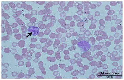 Peripheral Blood Smear Showing Large Myeloblasts With A High Nucleus To