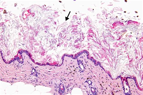 Hyperkeratosis Histology