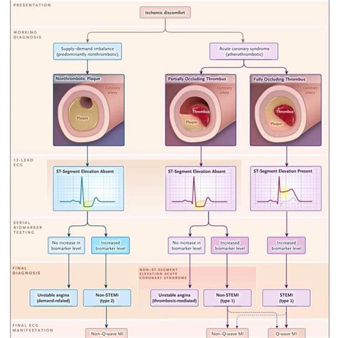 Membedakan Acute Vs Old Myocard Infarct Myocardial Infarction Ekg Hot Sex Picture