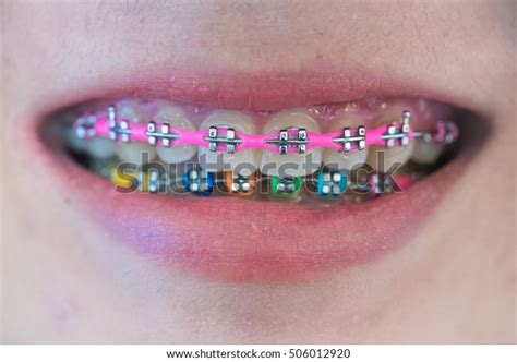 Colour Braces Smile: Over 5,425 Royalty-Free Licensable Stock Photos ...