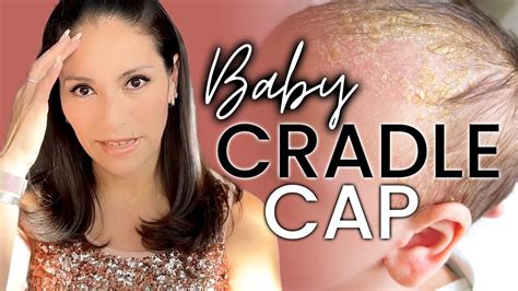 How Do You Get Rid Of Cradle Cap Cradlecap Baby Babyskincare Youtube