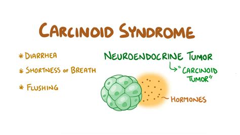 Carcinoid Syndrome Video Anatomy And Definition Osmosis