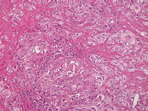 Squamous Cell Carcinoma Bladder Gross