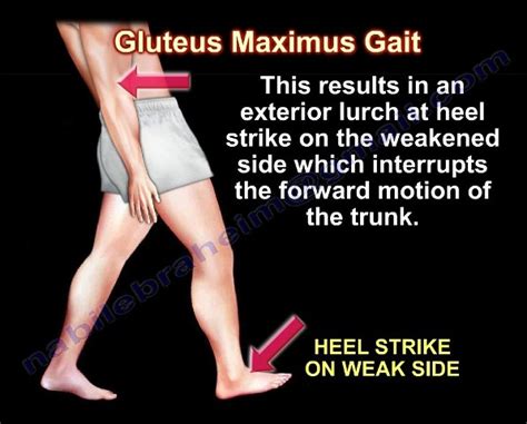 gluteus maximus gait I lurching gait - PHYSIO STUDY