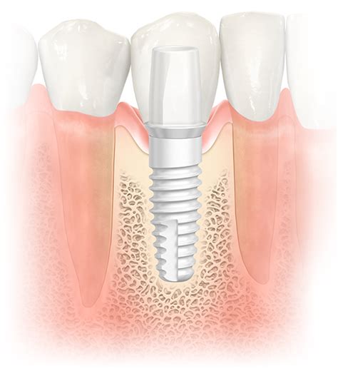 Qué son los implantes de zirconio Clínica Blasi