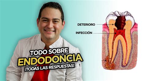 ENDODONCIA TODO Lo Que Necesitas Saber Sobre Los Tratamientos De