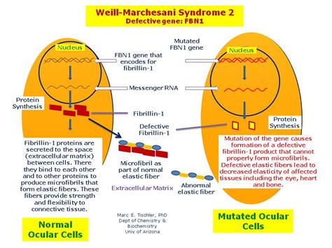 Weill Marchesani Syndrome 2 Hereditary Ocular Diseases