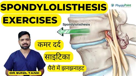 Spondylolisthesis Exercises Spondylolisthesis Physiotherapy Treatment