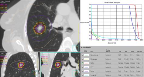 Stereotactic Ablative Radiotherapy For Early Stage Lung Cancer