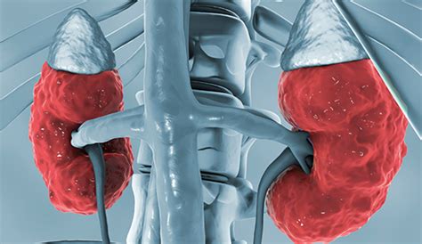 kidney practice  patients
